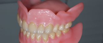 Основные особенности гибких зубных протезов