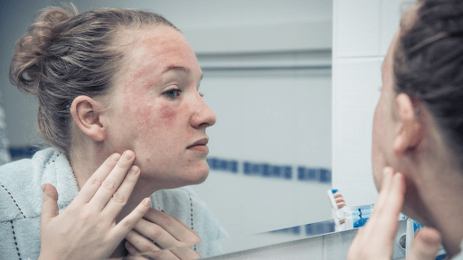 атопический дерматит на лице у подростков